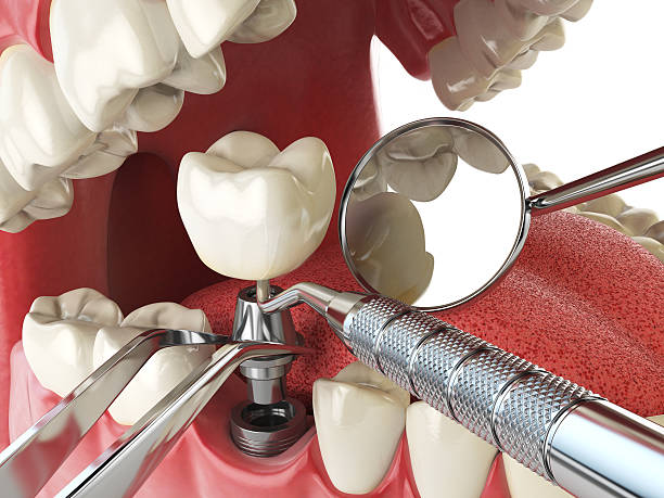 Best Dental Abscess Treatment in San Francisco, CA